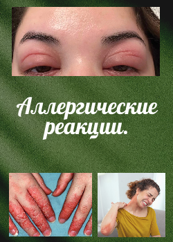 Аллергия.